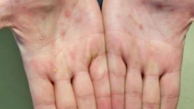 Bebés prematuros, viruela del mono, obesidad infantil, Sudán...Las noticias del miércoles